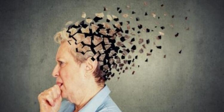 Alzheimer. Imagen referencial