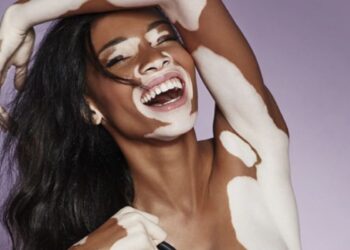 Chantelle Brown-Young, más conocida como Winnie Harlow, es una modelo canadiense-Jamaiquina y portavoz de la enfermedad de la piel llamada vitíligo. Saltó a la fama como concursante del ciclo 21 del programa de televisión estadounidense America's Next Top Model.